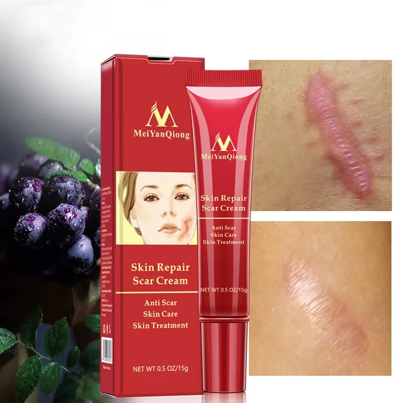 Acne scar removal cream