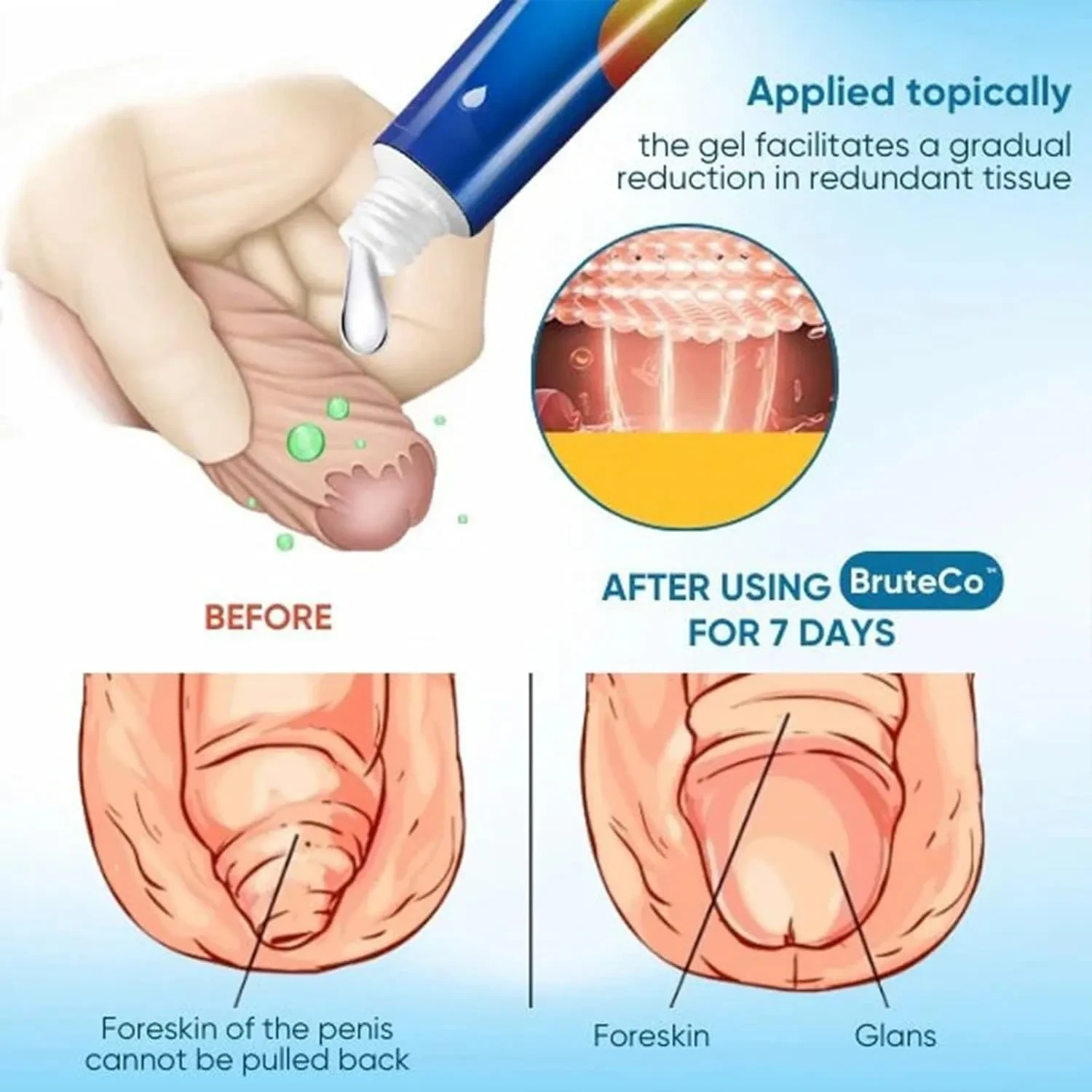 Prepuce Correction Gel