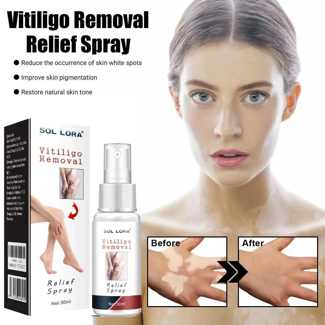 Vitiligo Removal Relief Spray
