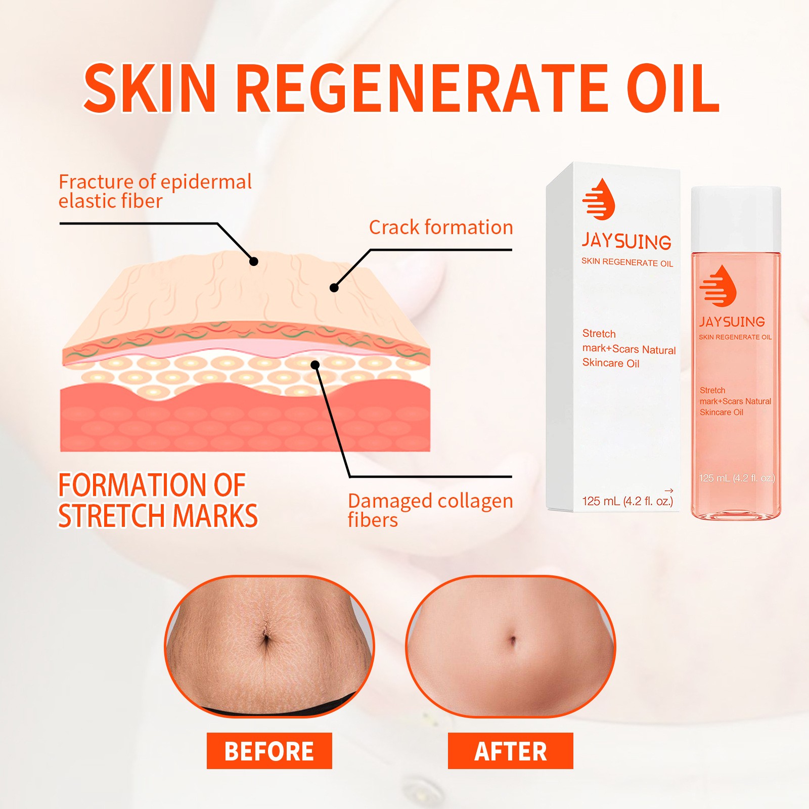 Jaysuing Skin Regenerate Oil  Stretch Mark & Scar Treatment