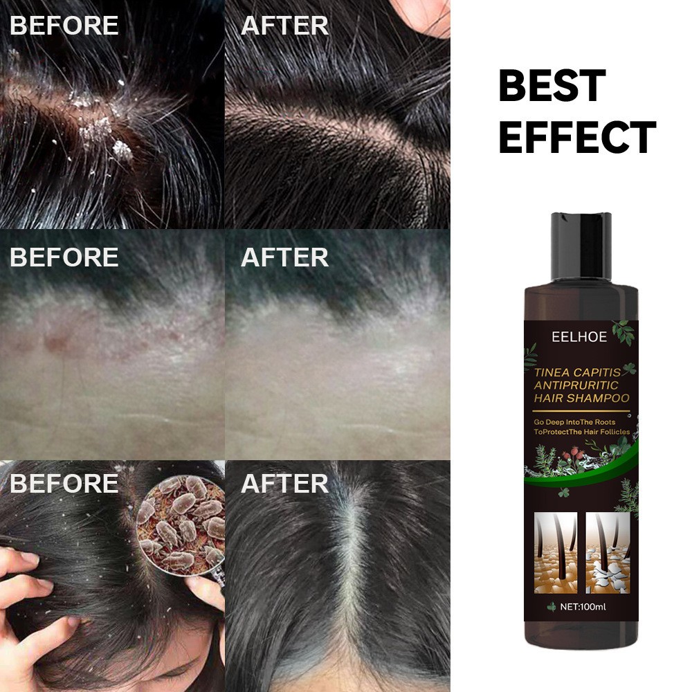 EELHOE Plant Formula Antipruritic Hair Shampoo Dandruff Control & Hair Follicle Protection