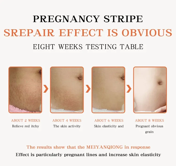 Acne Cream Stretch Mark Treatment Maternity Repair