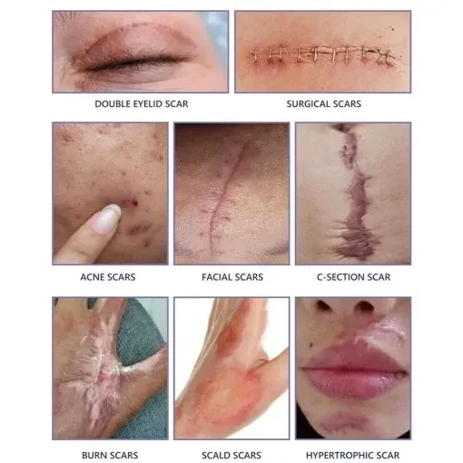 Advanced Scar Cream 20G