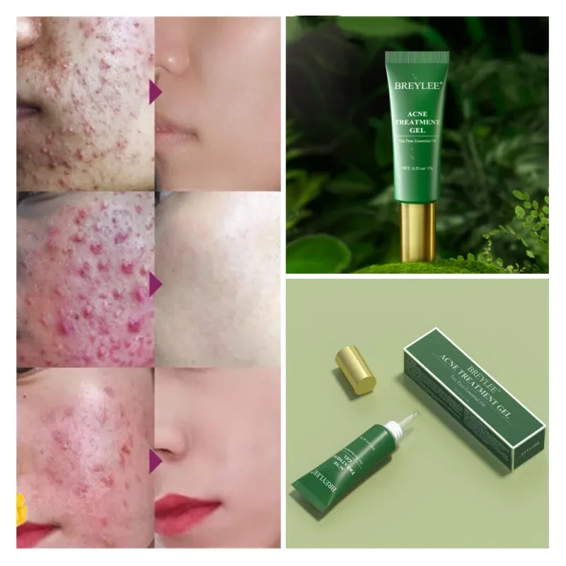 Tea Tree Acne Gel