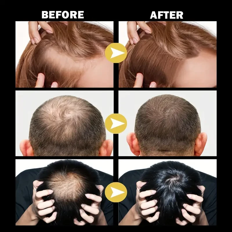 Minoxidil 5% Hair Growth Solution 30ml, 2-Pack - Biotin Hair Growth Serum Hair Regrowth Treatment For Regrow Hair, Thicken & Strengthen For Fuller, Healthier Hair