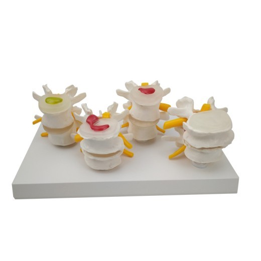 4-Stage Diseased Lumbar Spine Model Medical Teaching Equipment