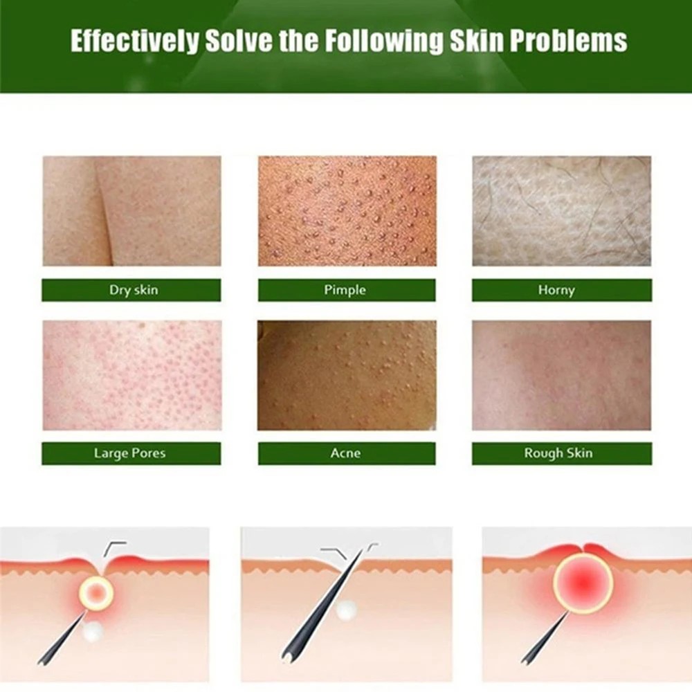 Chicken Skin Repair Cream - Keratosis Pilaris Treatment and Pore Smoothing