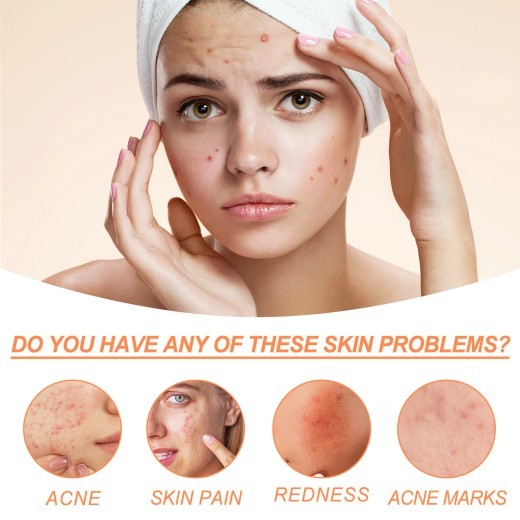 Salicylate Desalting Pimple Acne Marks Gentle And Clean