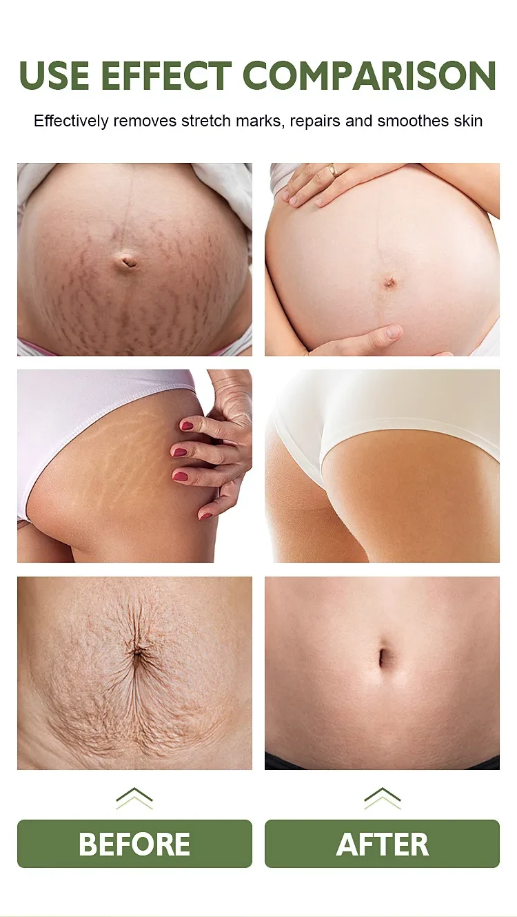 Stretch Mark Cream Fat Body Pattern Recovery Cream